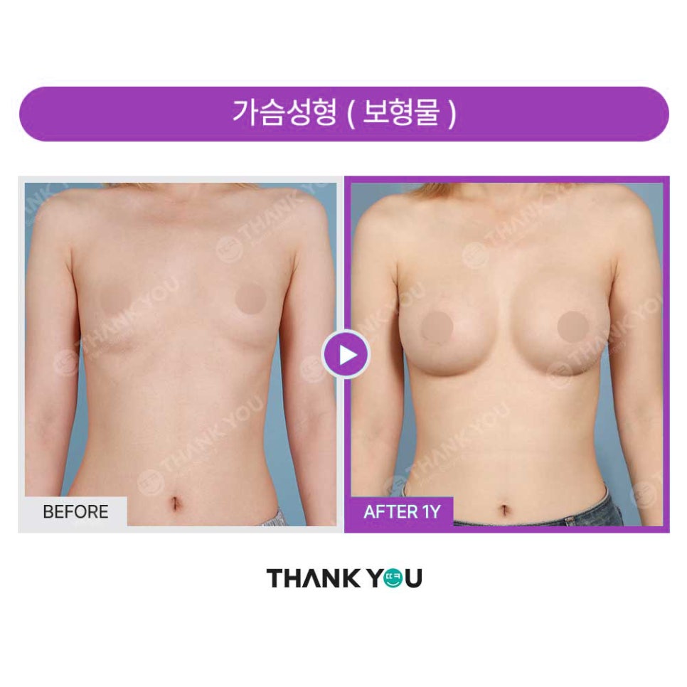강남 가슴성형외과, 흉곽과 체형을 고려한 모티바보형물 관련 이미지 17