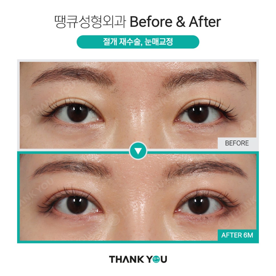 땡큐 절개쌍꺼풀 전후사진 (절개후 재수술 여부, NO?가능!) 관련 이미지 3