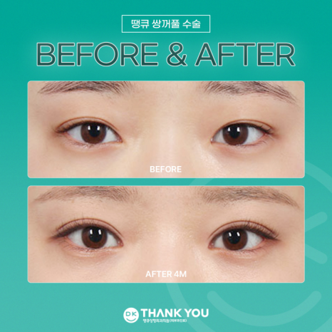 Double-Eyelid Surgery Line: Which One Suits Me Best? image 11