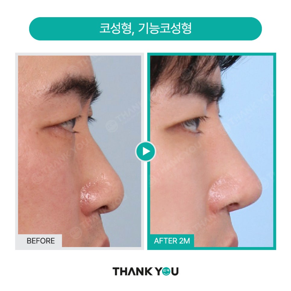 MAKE미남(맥미남) 오덕차장님의 노안 개선&남자 비염코성형 전후 관련 이미지 12