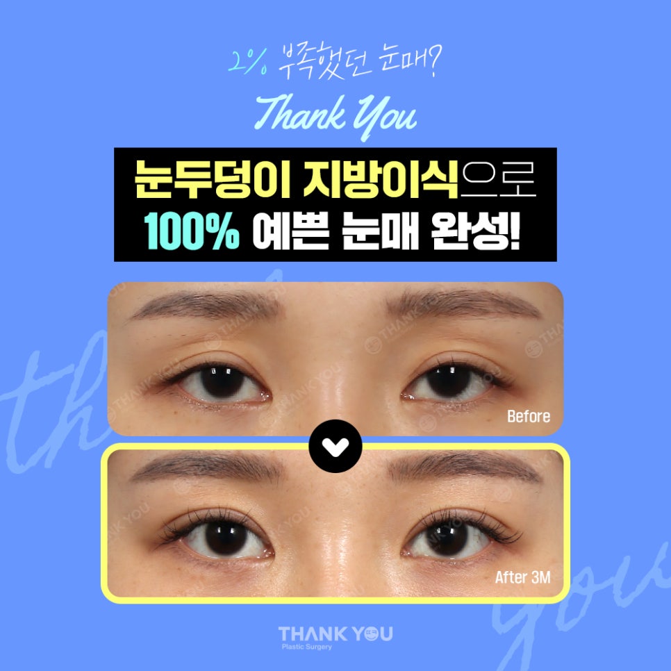 눈두덩이 지방이식, 푹꺼진 눈꺼풀에 자가지방이식으로 관련 이미지 10