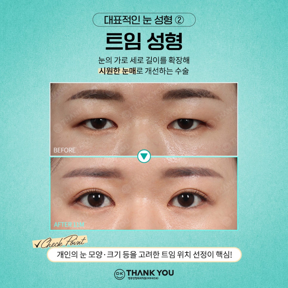 첫눈성형 후기 좋은 땡큐에서 만드는 예쁜 눈매💚 관련 이미지 5