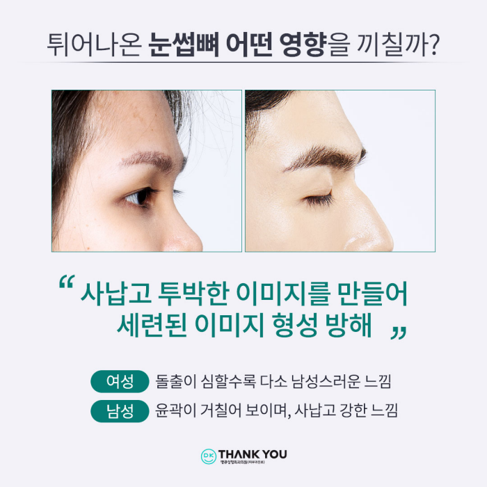 눈썹뼈돌출로 강한 인상, 땡큐 눈썹뼈쉐이빙으로 개선! 관련 이미지 2