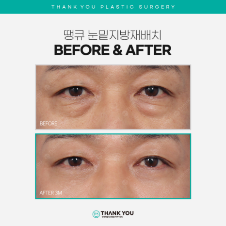 Recommended Under-Eye Fat Repositioning! Transform Your Look to Be Brighter and More Vibrant! image 12