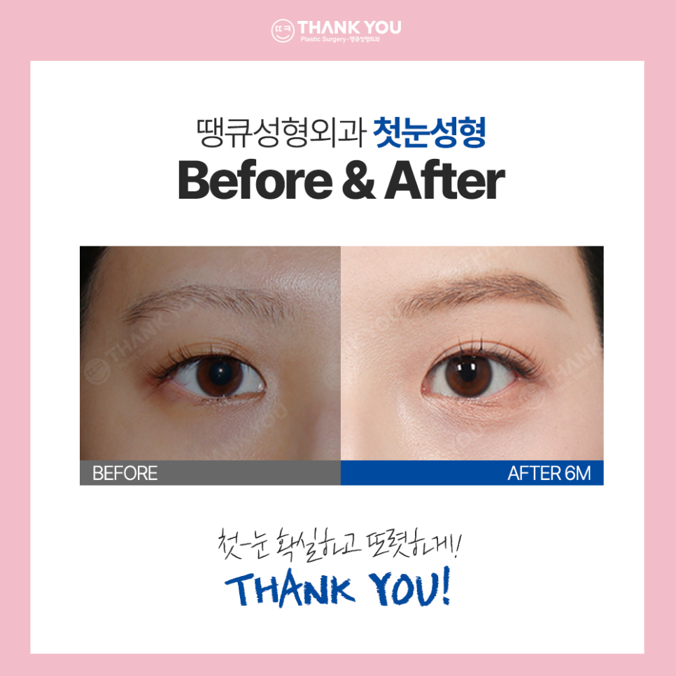 수능 끝나면 수험생 버킷리스트? 수험생 눈코 성형 전후Check 관련 이미지 7