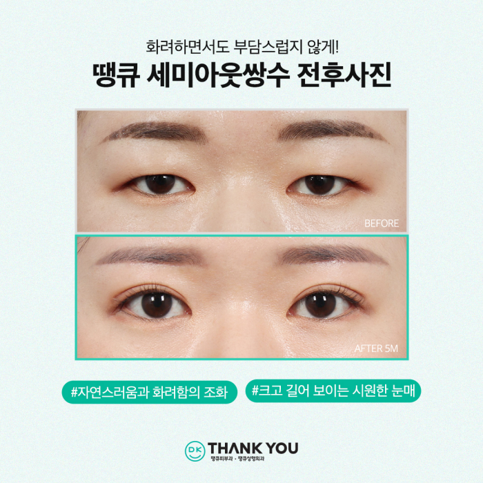 쌍수잘하는곳에서 세미아웃라인쌍꺼풀로 예쁜 눈 변신! 관련 이미지 8