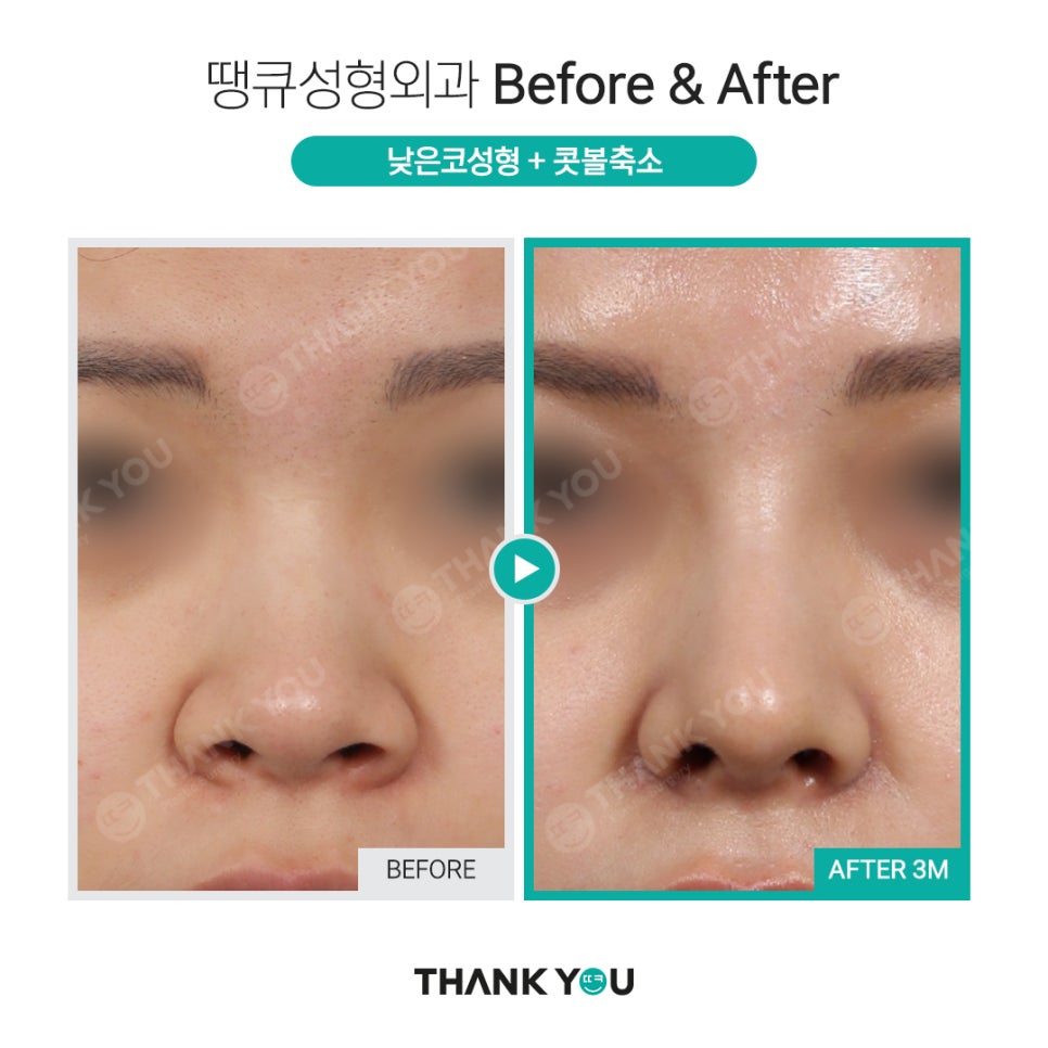 코 성형전, 코필러 꼭 제거해야 하나요? [코 수술전 필독!] 관련 이미지 9