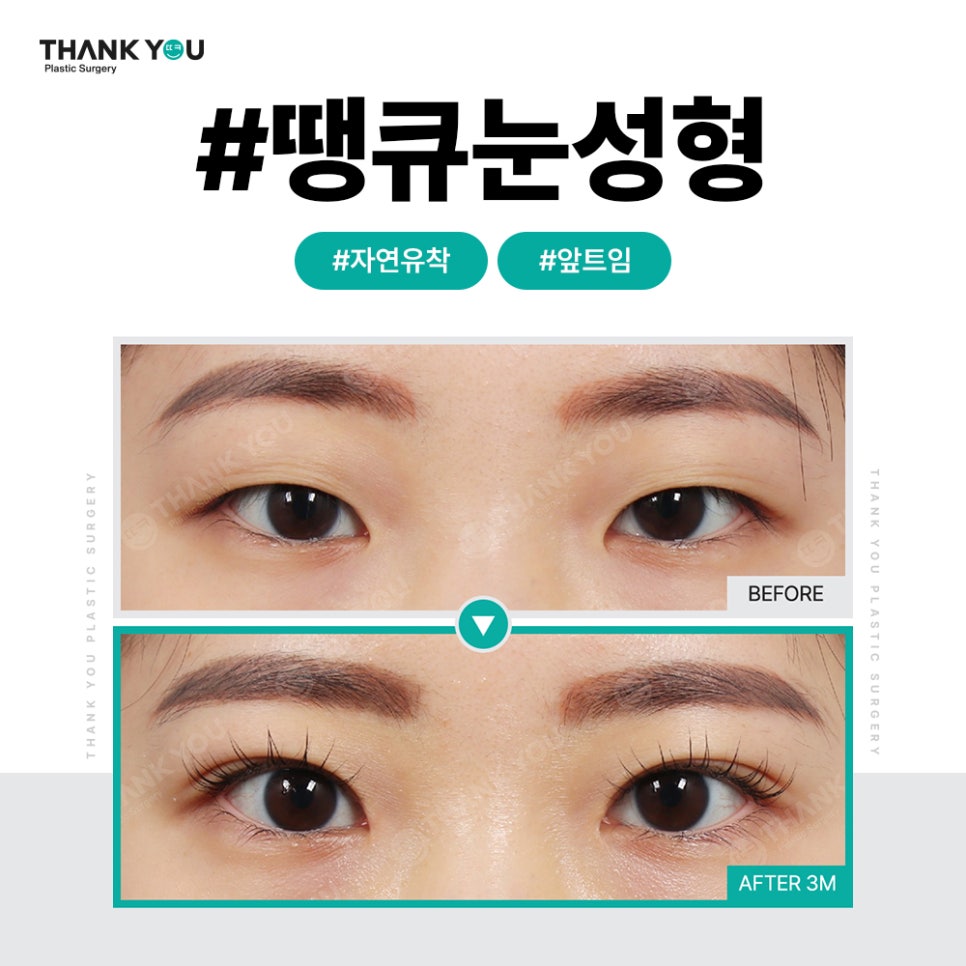 쌍꺼풀 라인 종류, 내게 맞는 쌍수랑 트임은?(인라인) 관련 이미지 9