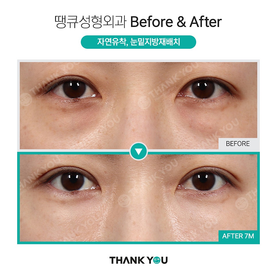 눈밑수술, 눈밑지방이식도 가능한가요? 관련 이미지 13