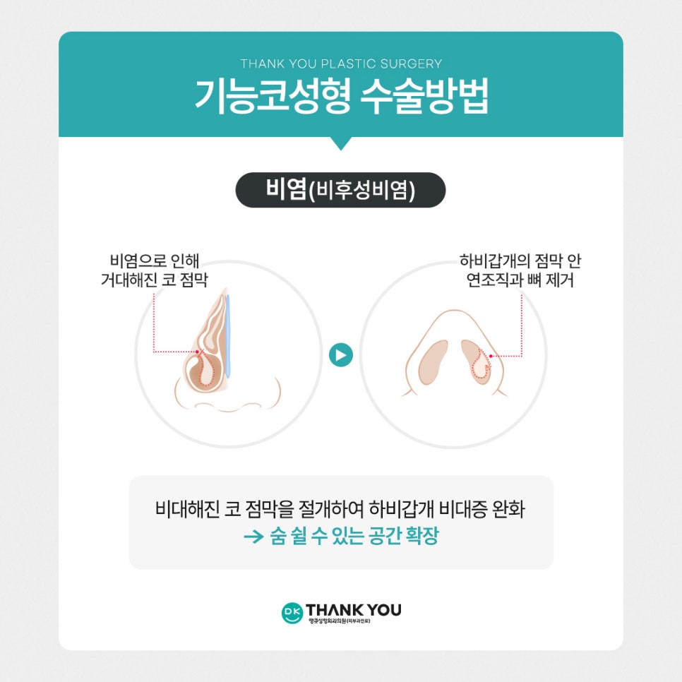 기능코성형, 비염수술코성형 유형별 수술법 알아보기 관련 이미지 9