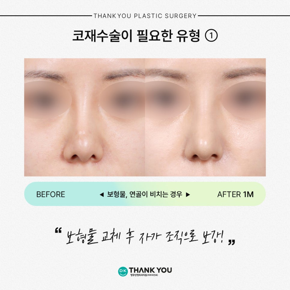 코재수술잘하는곳 땡큐가 제안하는 유형별 수술 방법은? 관련 이미지 3