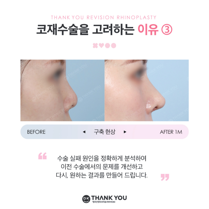 코재수술잘하는병원 땡큐 이벤트✨ 관련 이미지 4