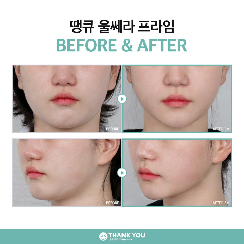 울쎄라프라임 효과로 얼굴 전체 탄력 개선과 리프팅을 동시에! 관련 이미지 8