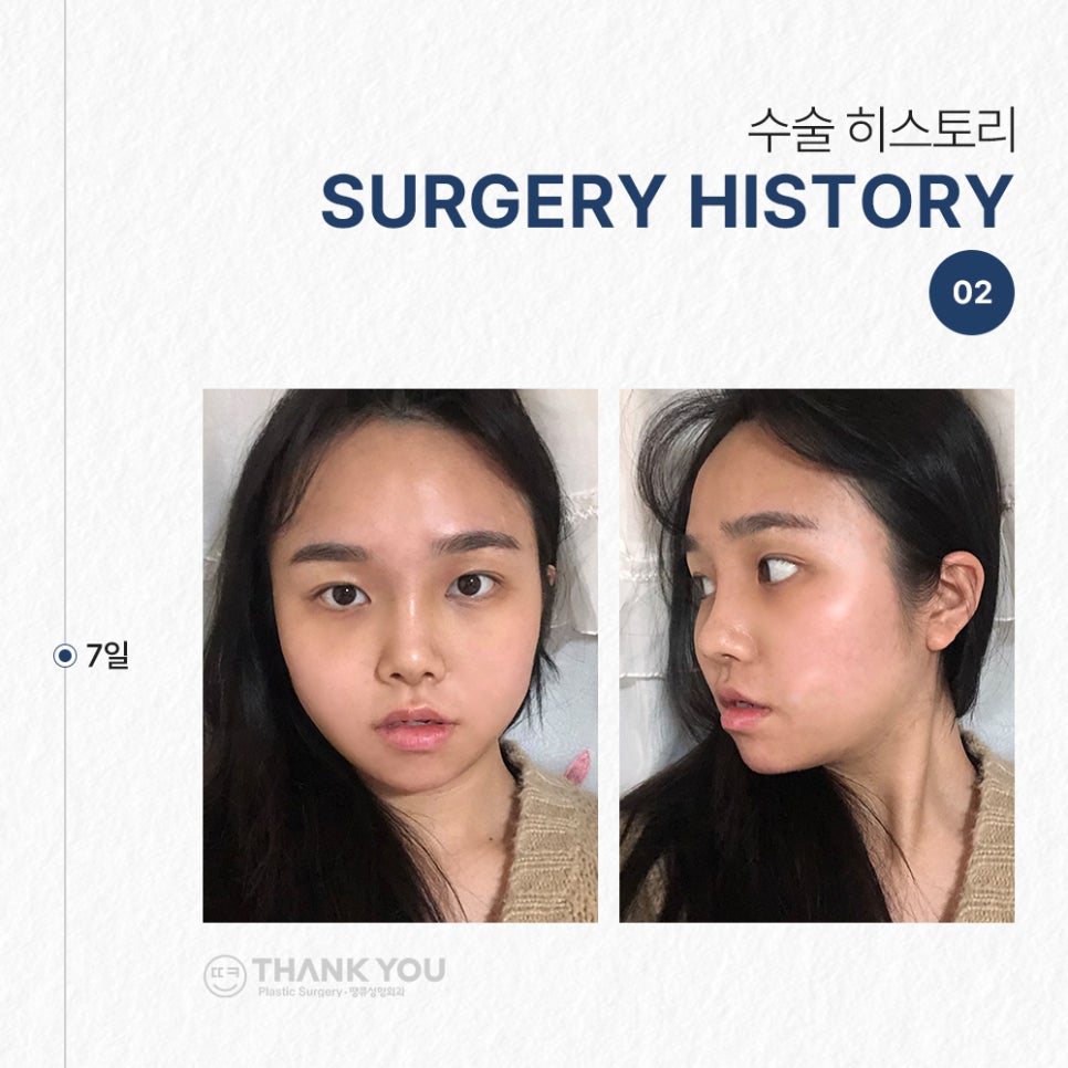 낮은코성형&얼굴지방흡입 후기 (땡큐성형외과 Real Story) 관련 이미지 5