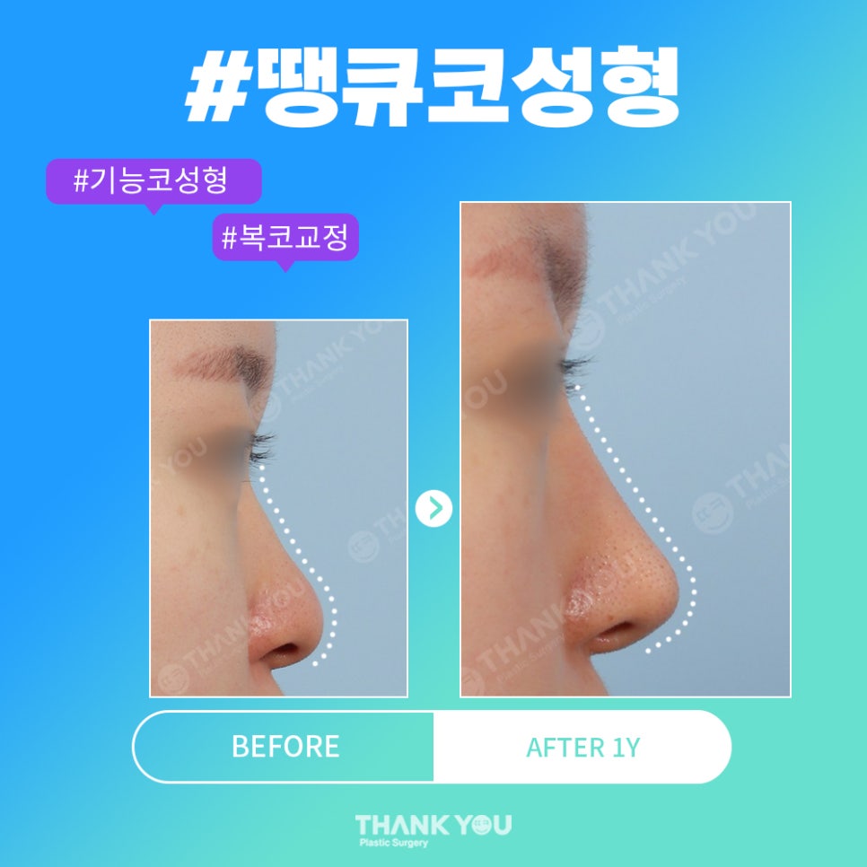 코성형 전후, 코모양 신논현역 성형외과에서 체크 관련 이미지 4