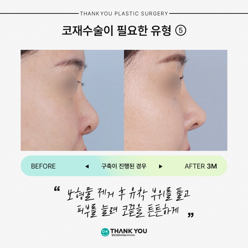 코재수술잘하는곳 땡큐가 제안하는 유형별 수술 방법은? 관련 이미지 7