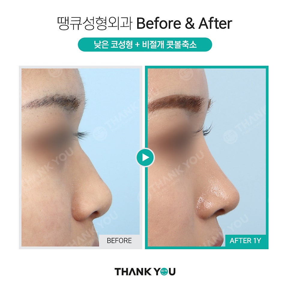 코성형, 비공내리기 수술이란? [콧구멍 잘 보이는 용코 개선] 관련 이미지 11