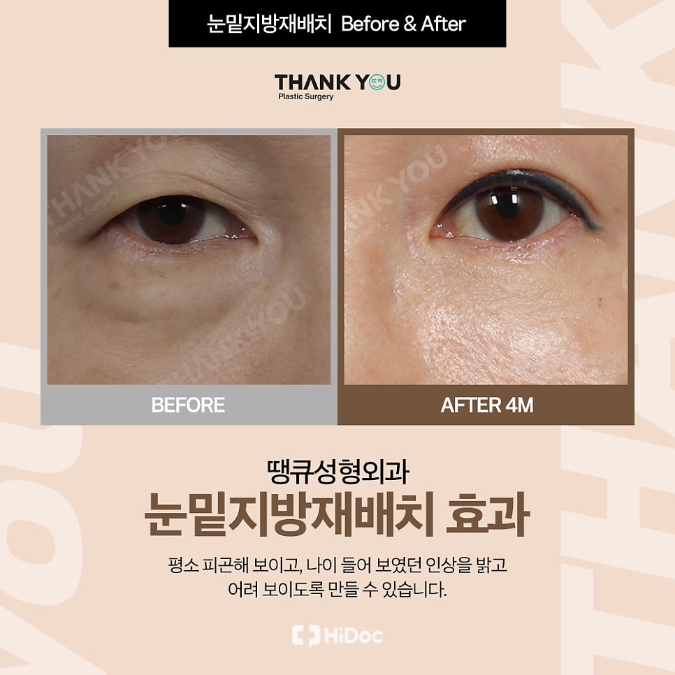 눈밑지 지방이식? 앞광대지방이식 필요한 이유? 관련 이미지 5