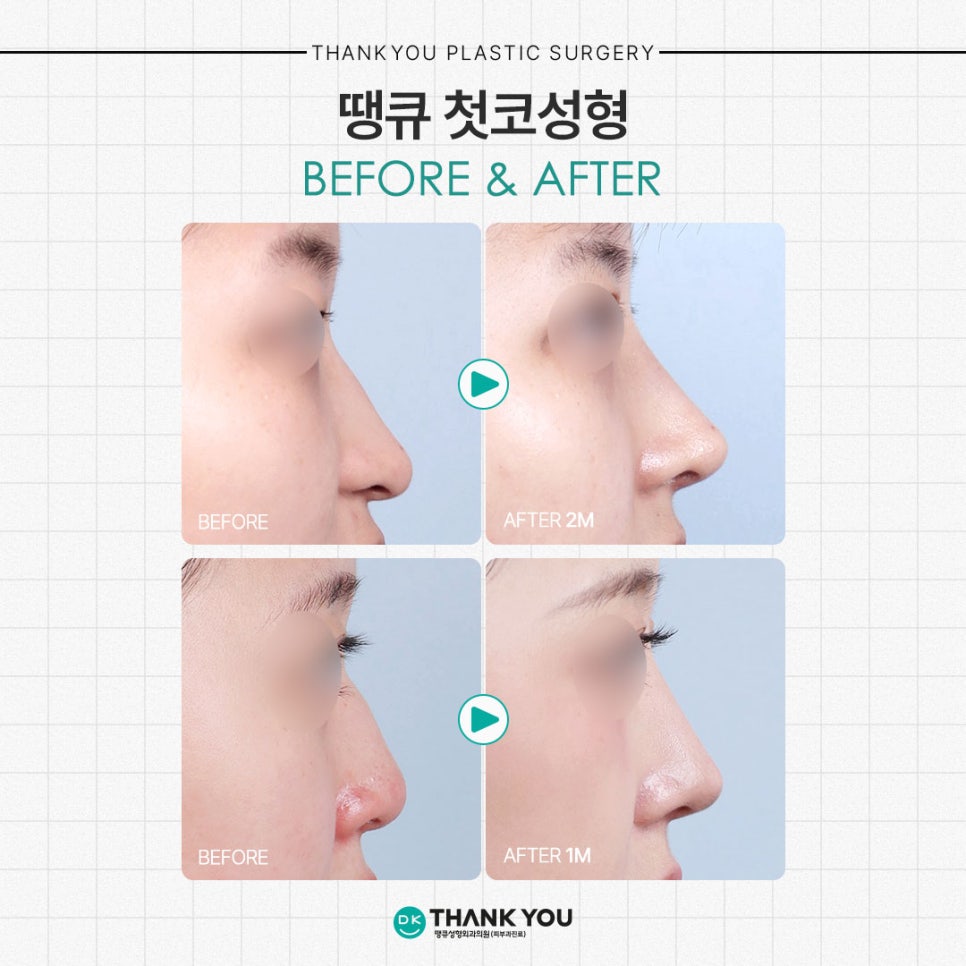 What Checkpoints Should You Consider Before Your First Rhinoplasty?! image 10