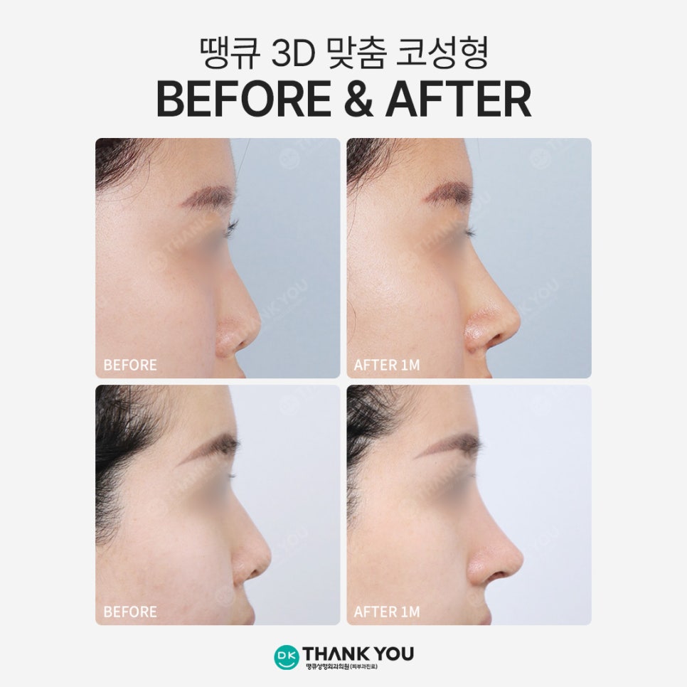 땡큐성형외과 권정우 원장, 코수술재료 관련 이미지 12