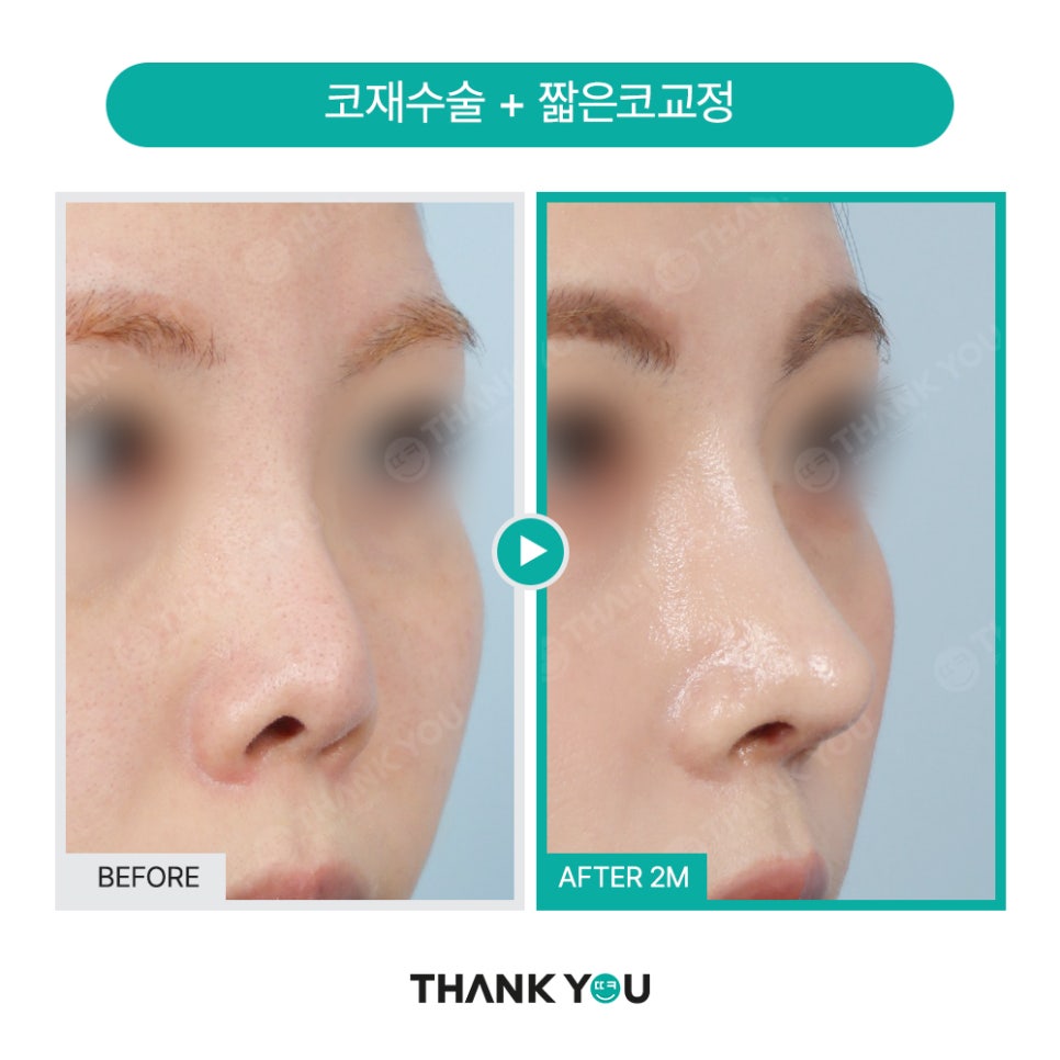 자가늑연골 코수술 장단점, 실리콘없이 무보형물 전후Check 관련 이미지 18