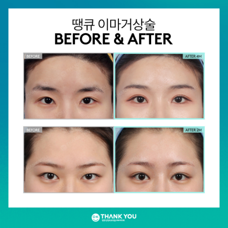 What Are the Effects of a Forehead Lift?[Column by Director Kim Gyu-beom] image 9