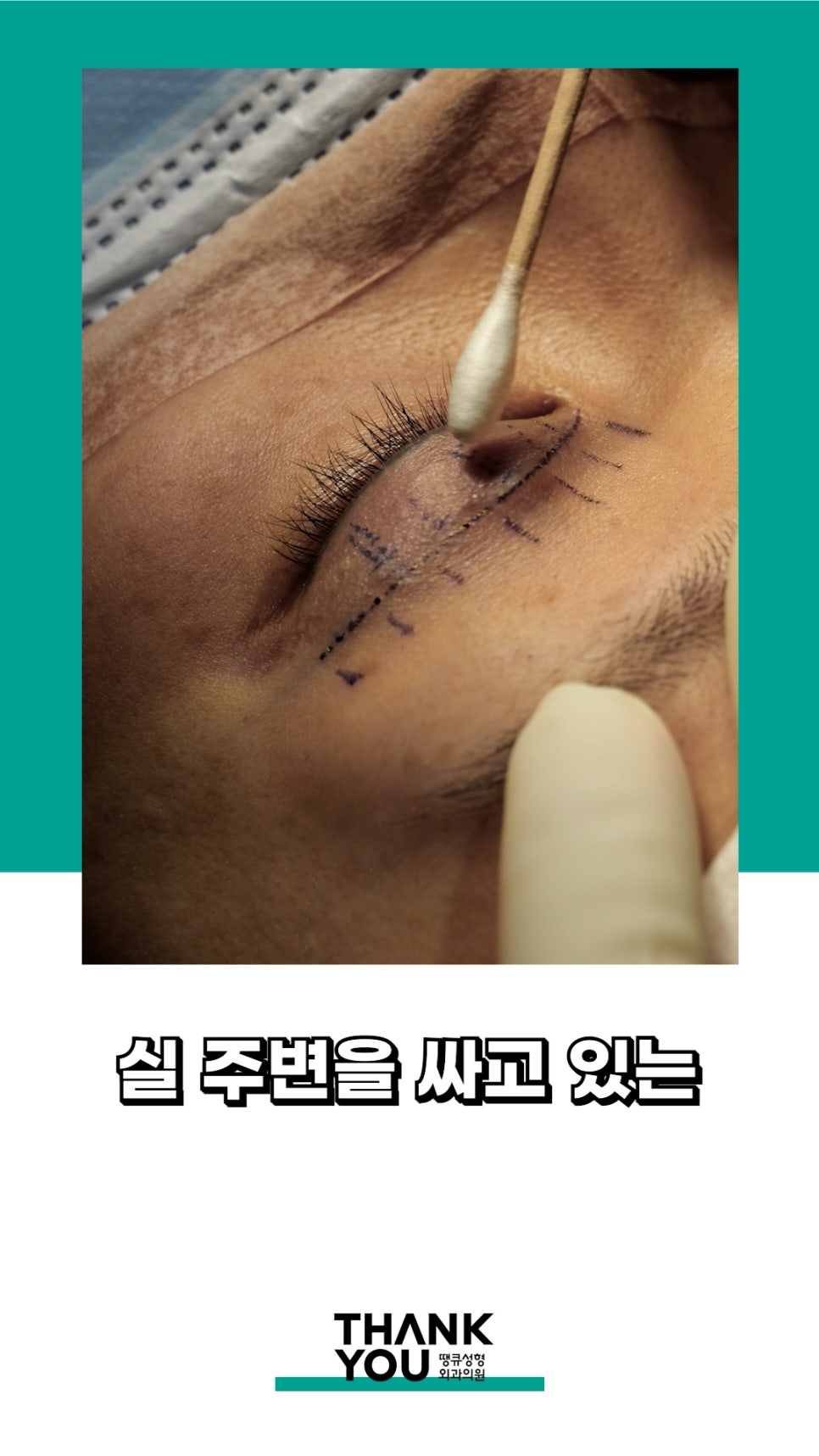 3번 눈재수술? 근데 실제거를 안했다고? 땡큐에서 전부 실제거! 관련 이미지 7