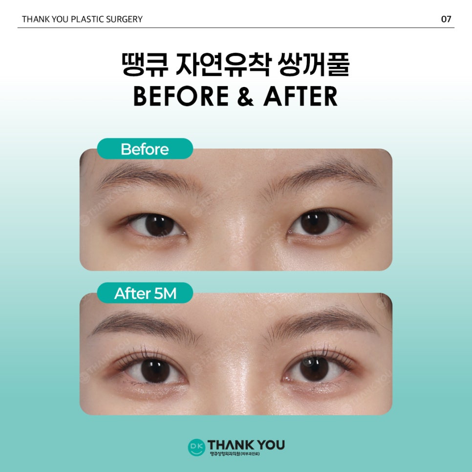 Natural Adhesion Double Eyelid Surgery Done Well: Naturally, as if It Were Meant to Be, at Thank You! image 8