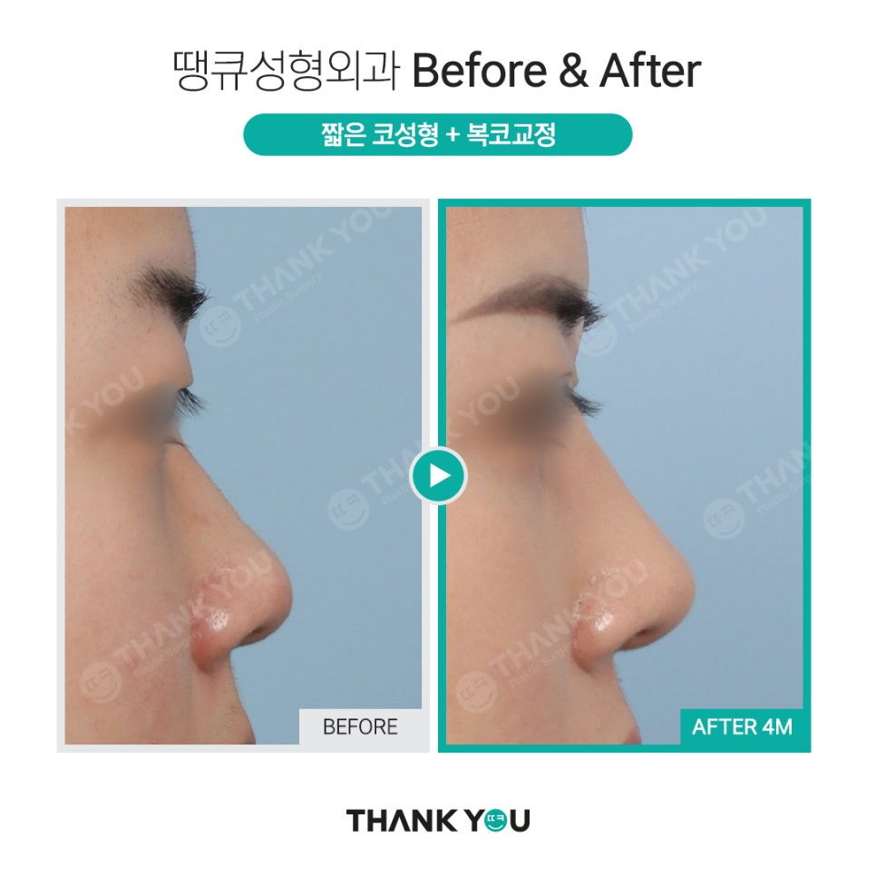 강남 코성형 전후, 코수술 잘하는 곳? 관련 이미지 7