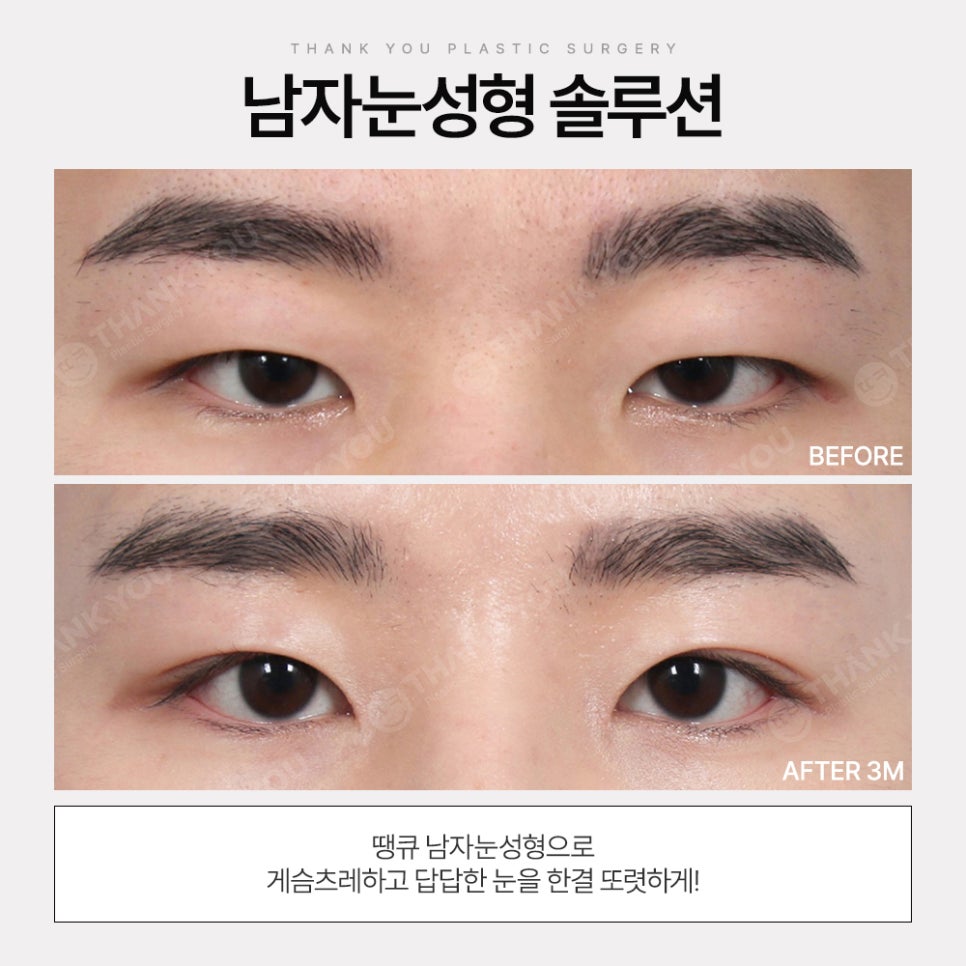 땡큐 남자눈성형 솔루션 (ft. 남자비절개 눈매교정 전후) 관련 이미지 6