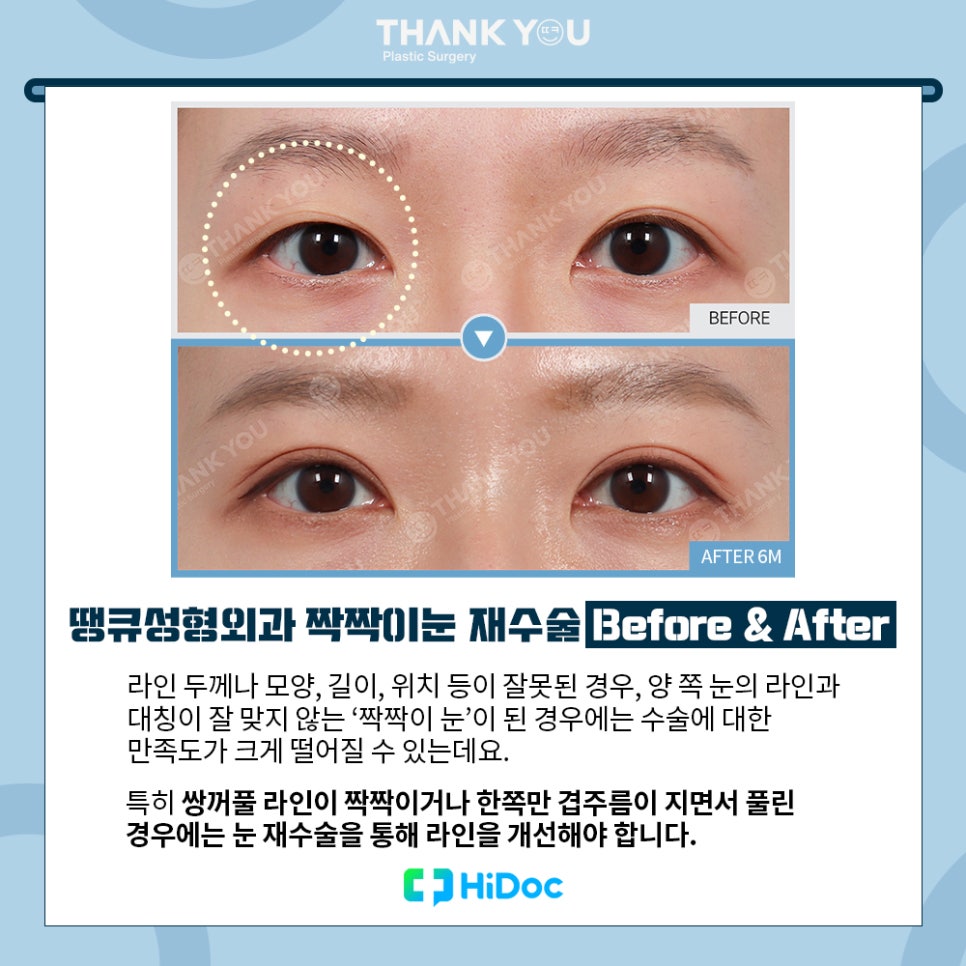 강남 눈재수술, 짝짝이눈 교정 방법 라인 대칭 성공 포인트 관련 이미지 2
