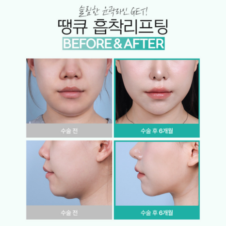 땡큐성형외과 이벤트 : 얼굴윤곽라인 개선엔?! 흡착리프팅 관련 이미지 9