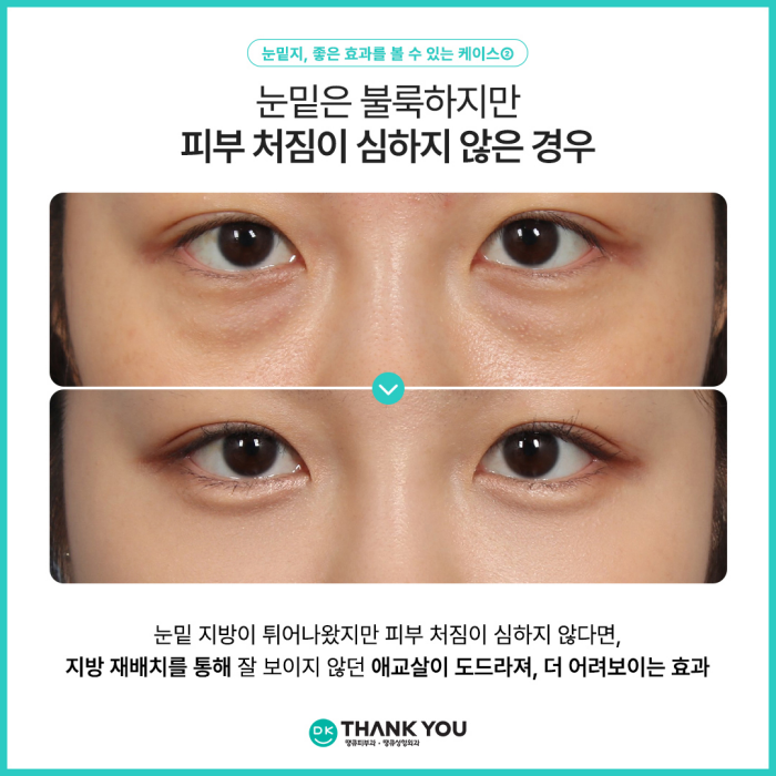 눈밑지병원에서 알려주는 눈밑지방재배치 추천 대상! 관련 이미지 4