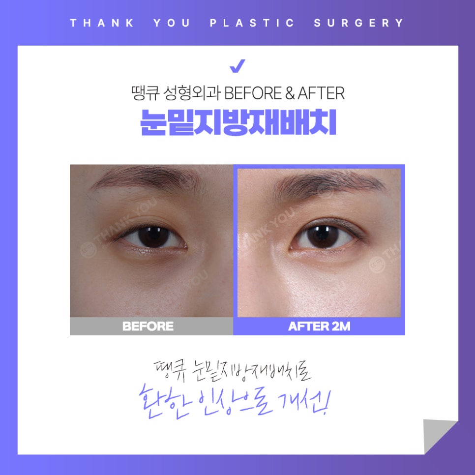 눈밑 불룩? 눈밑지방재배치 수술 후에도 재발할까? 관련 이미지 9