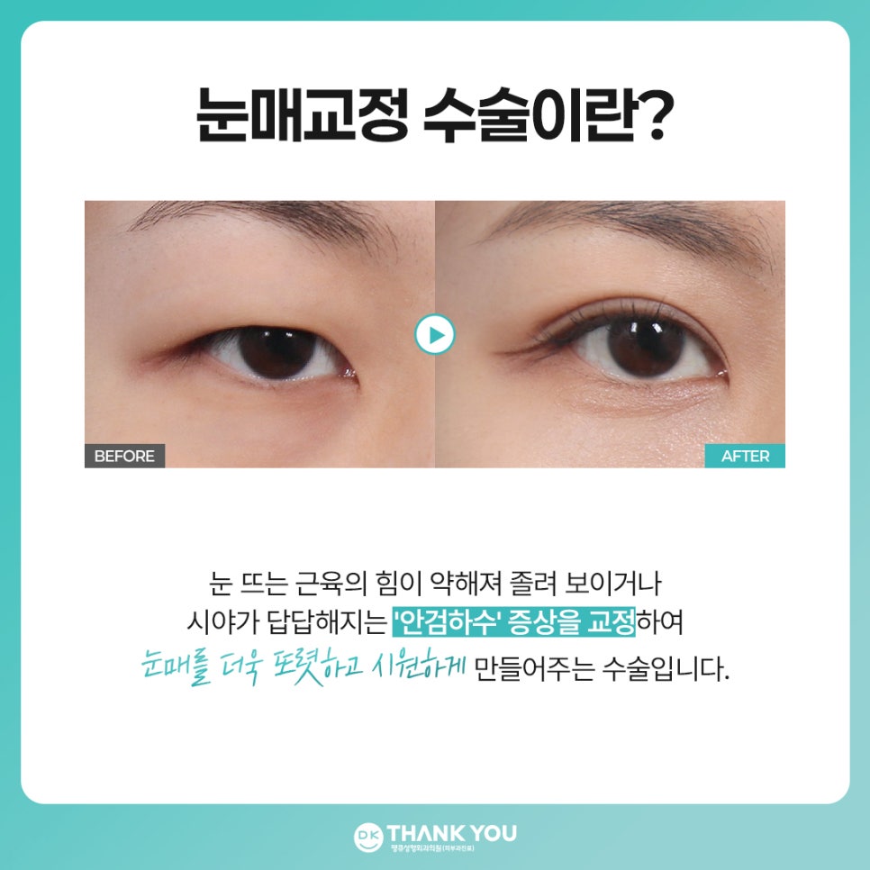 비절개 눈매교정 vs 절개 눈매교정 뭐가 다를까? 관련 이미지 2