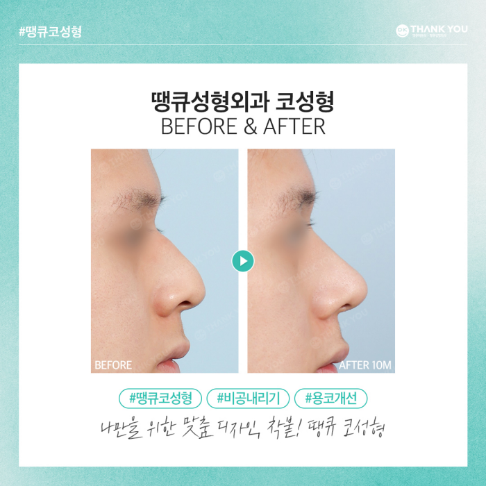 비공내리기로 용코교정하고 조화로운 코 만들기🍀 관련 이미지 11