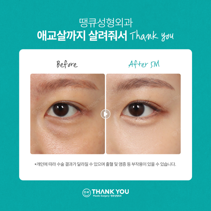 눈밑지방재배치잘하는곳은 이렇게 합니다✨✨ 관련 이미지 7