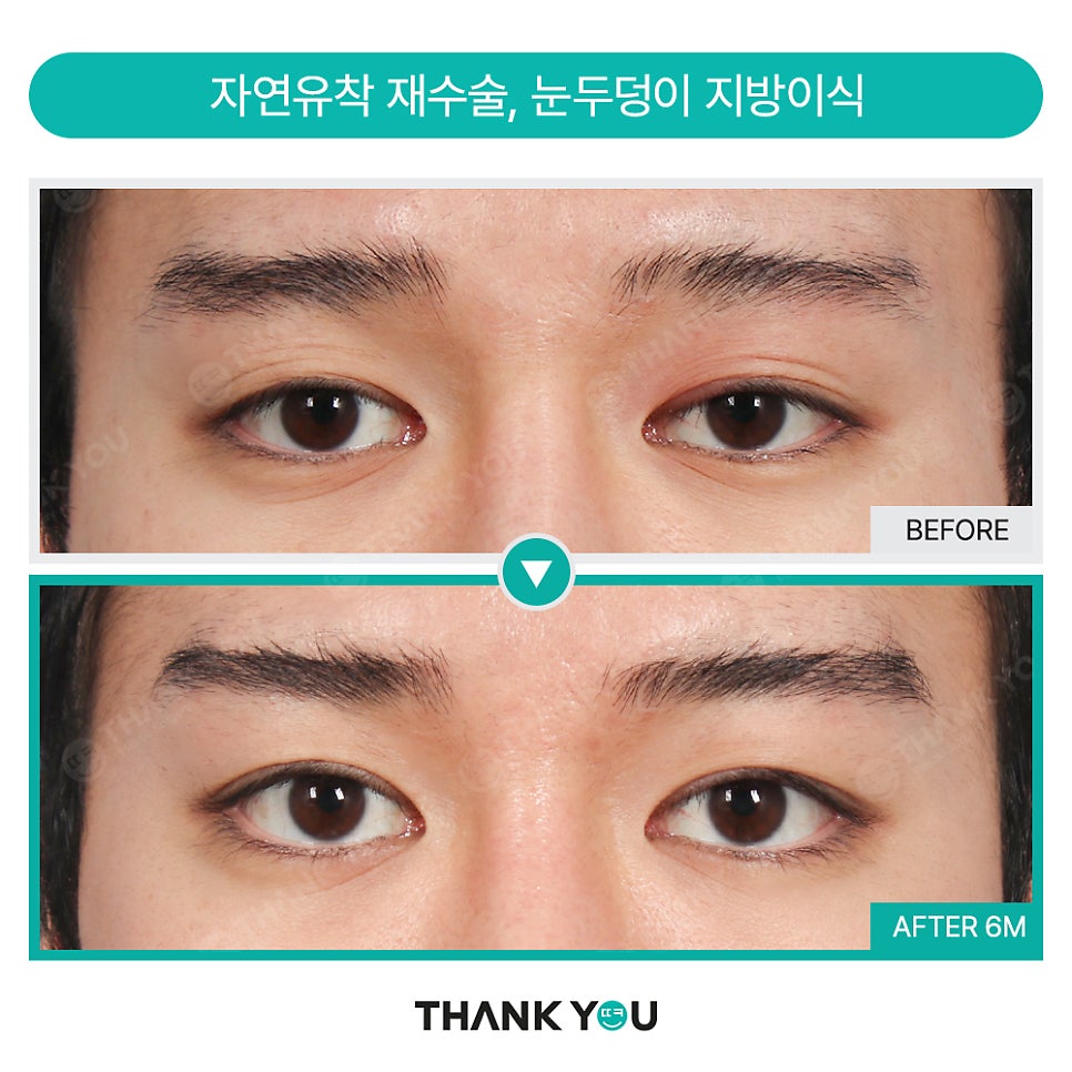 눈밑지방재배치 함께 필요한 미세 지방이식?(땡큐 나노펫) 관련 이미지 12