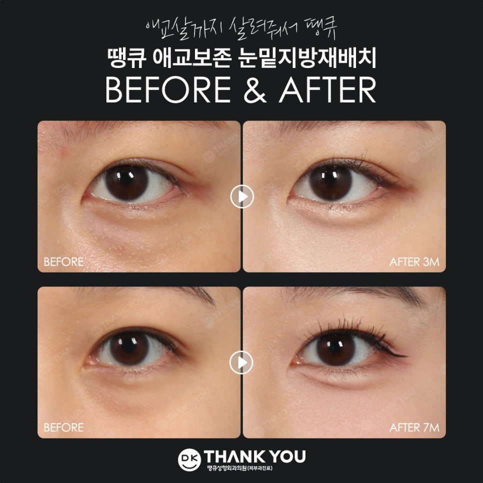 A Place That Does Lower Eyelid Fat Repositioning Well — Complete a Smooth, Refreshed Under-Eye Look at Thank You! image 10