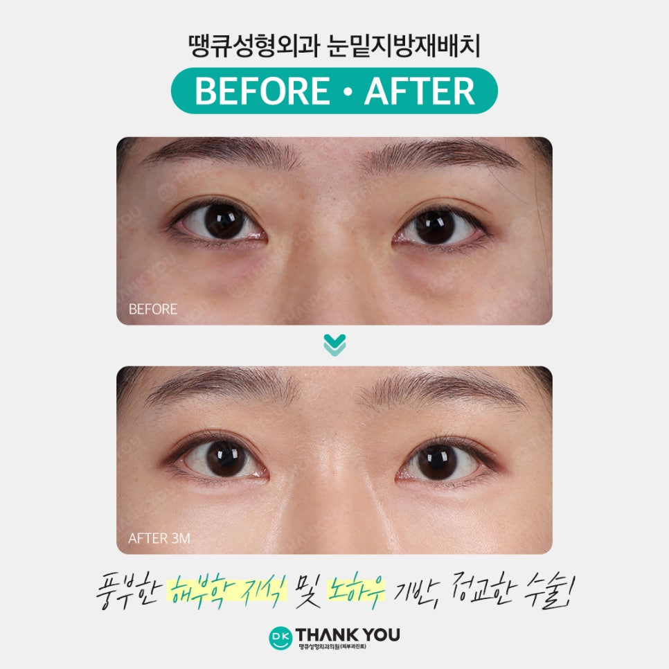 Under-Eye Fat Repositioning Side Effects: What Are the Causes and Treatment Methods?! image 6
