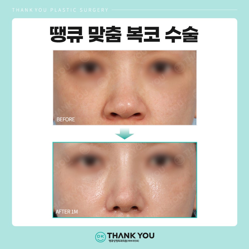 복코수술후기? 세련된 이미지 만드는 땡큐에서 확인! 관련 이미지 8