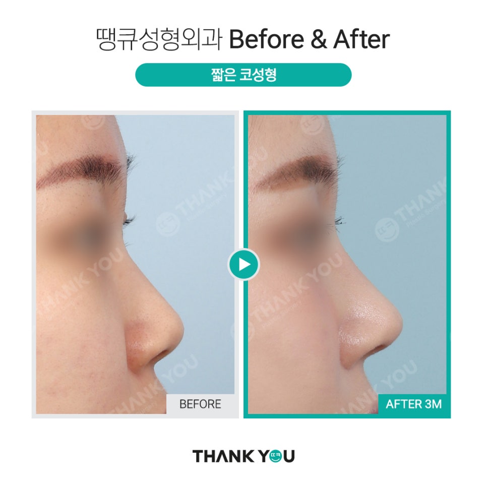짧은코 교정의 역발상, 짧은코 성형 전후 관련 이미지 7