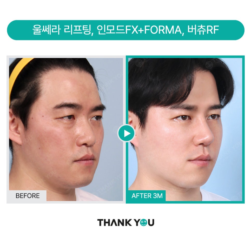 MAKE미남(맥미남) 오덕차장님의 노안 개선&남자 비염코성형 전후 관련 이미지 16