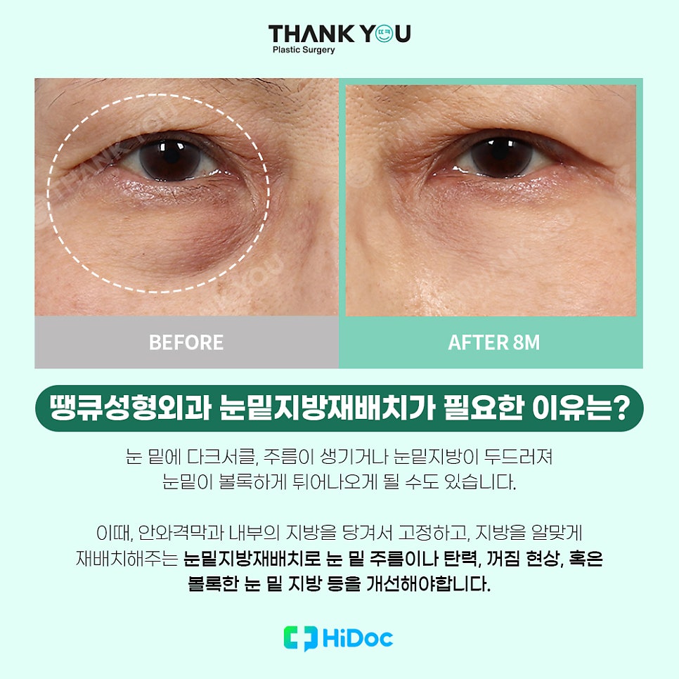 (눈밑지방불룩함)눈 지방 볼록한 이유or눈밑지 수술후 주의사항 관련 이미지 3
