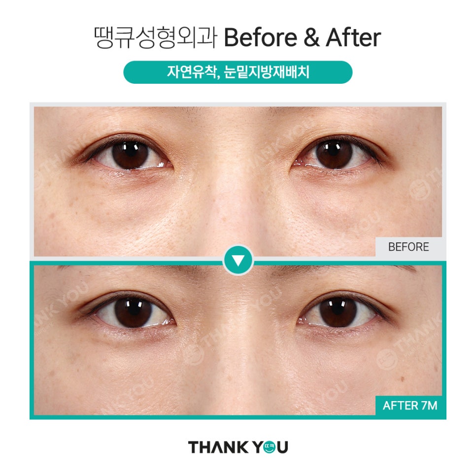 눈밑수술, 눈밑지방이식도 가능한가요? 관련 이미지 12