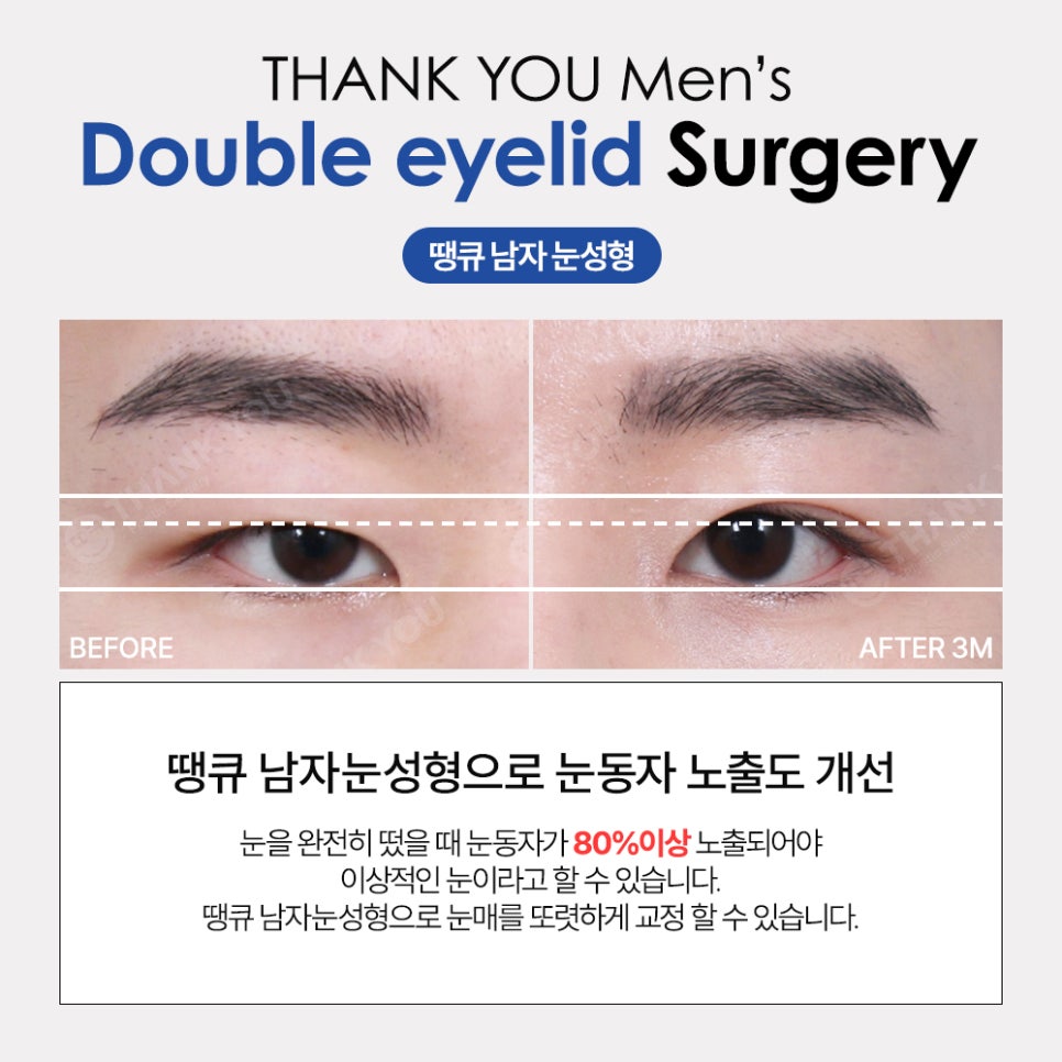 땡큐 남자눈성형 솔루션 (ft. 남자비절개 눈매교정 전후) 관련 이미지 4