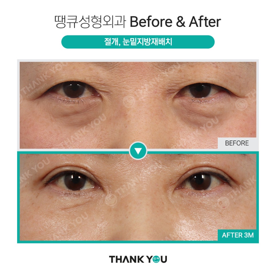 하안검과 눈밑지방재배치의 차이점? 관련 이미지 15