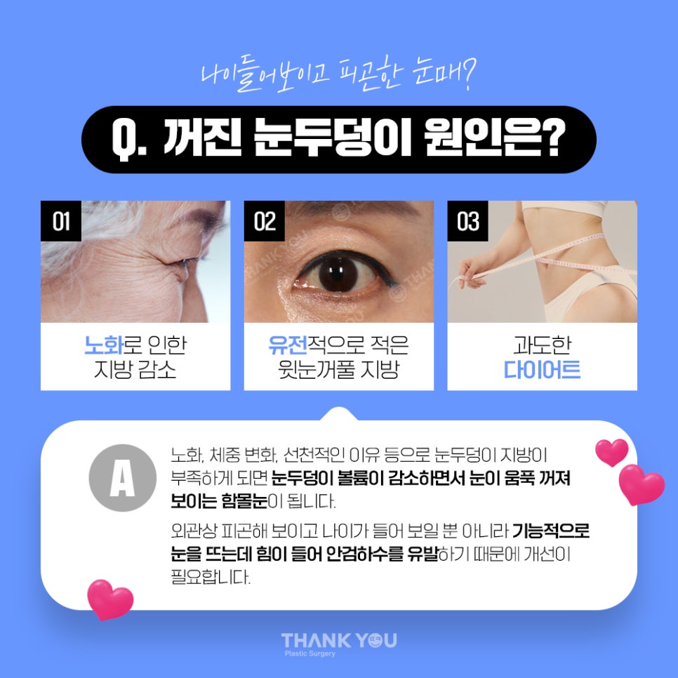 눈두덩이 지방이식, 푹꺼진 눈꺼풀에 자가지방이식으로 관련 이미지 9