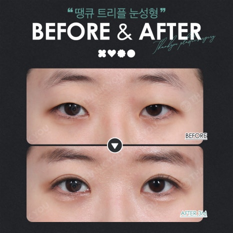 Thank You’s Exam Taker Event at a Great Place for Eye Surgery! ✨Triple Eye Surgery✨ image 11