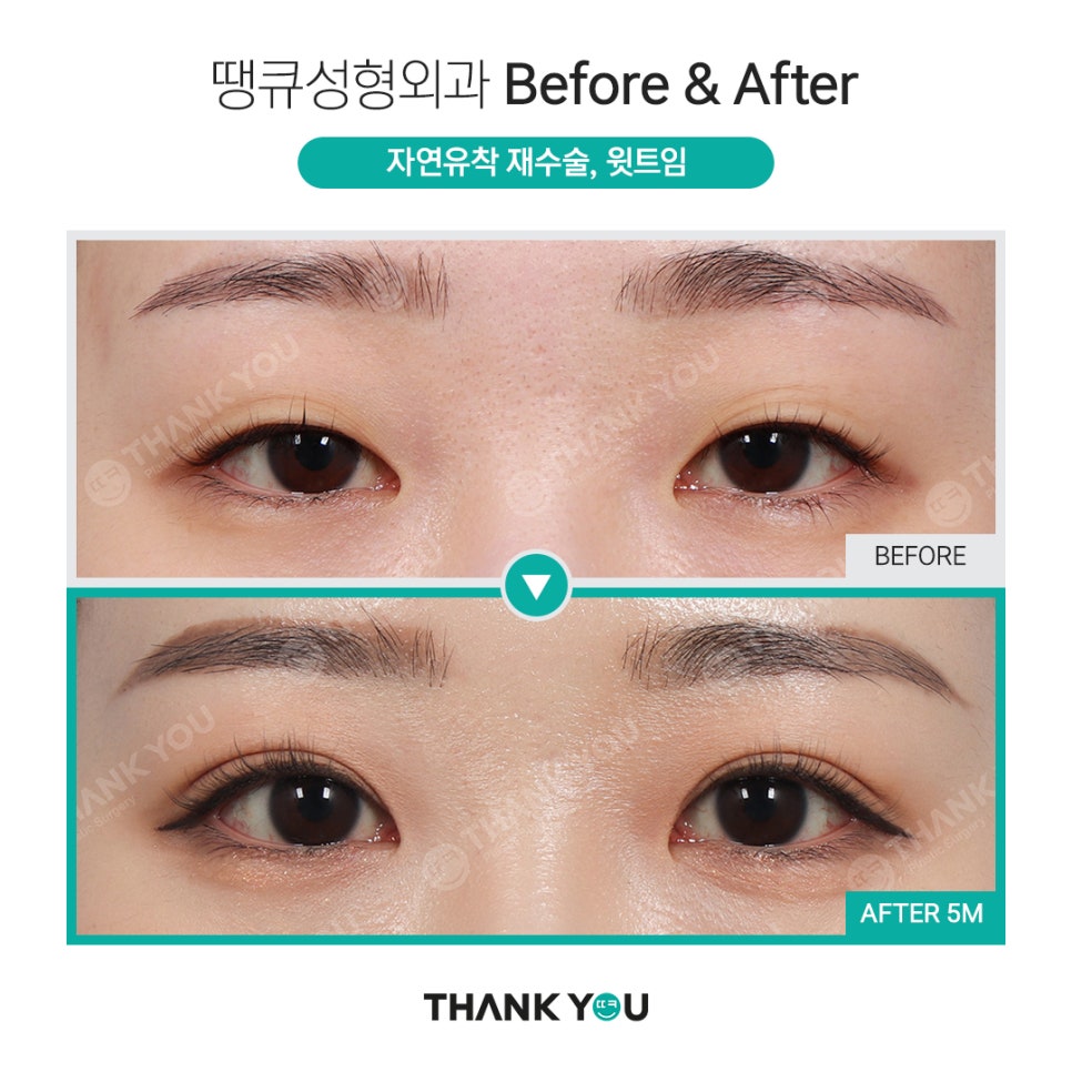 쌍수 풀기 (재수술전 실풀기+ 눈재수술 전후) 관련 이미지 1